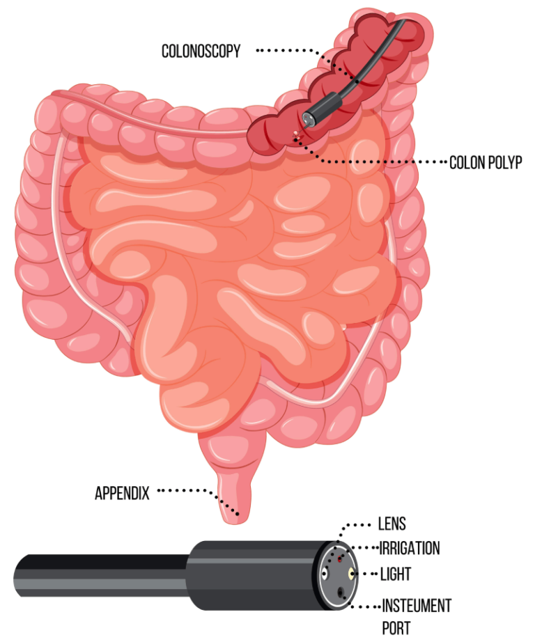 Best Colonoscopy Procedure, Haveri | Colonoscopy Specialist